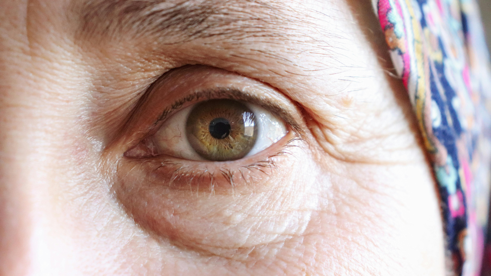 Preauricular Rhytids What do wrinkles (lines, rhytids, folds) mean? | ArokaGO