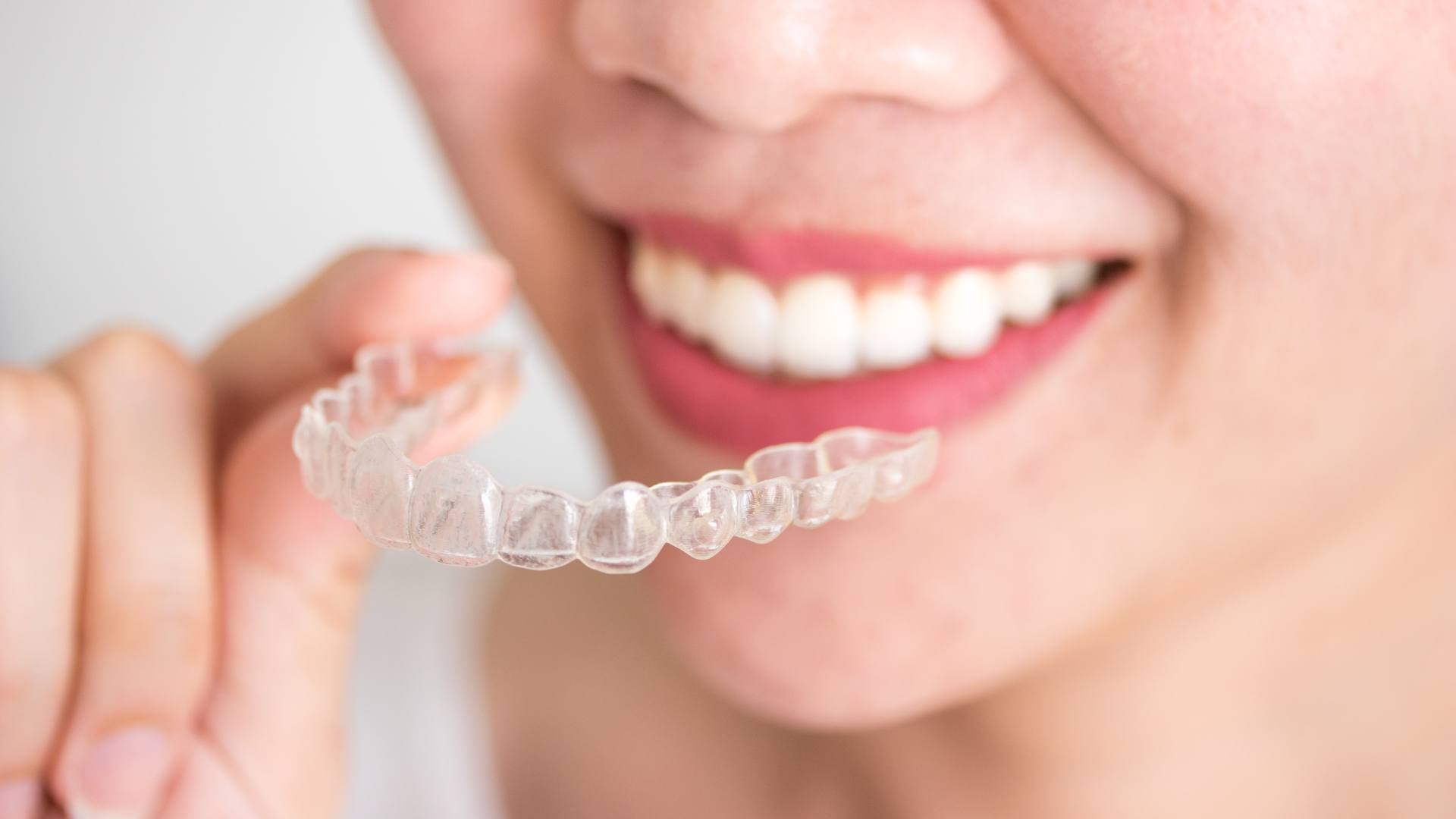 10 Reasons Why the New Generation Prefers Invisalign Clear Aligners ...
