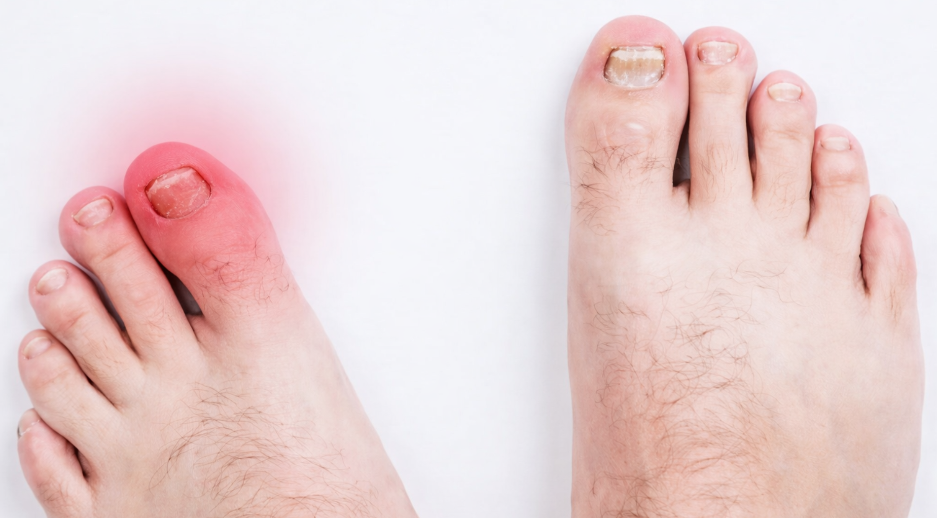  Ingrown Toenails Treatments