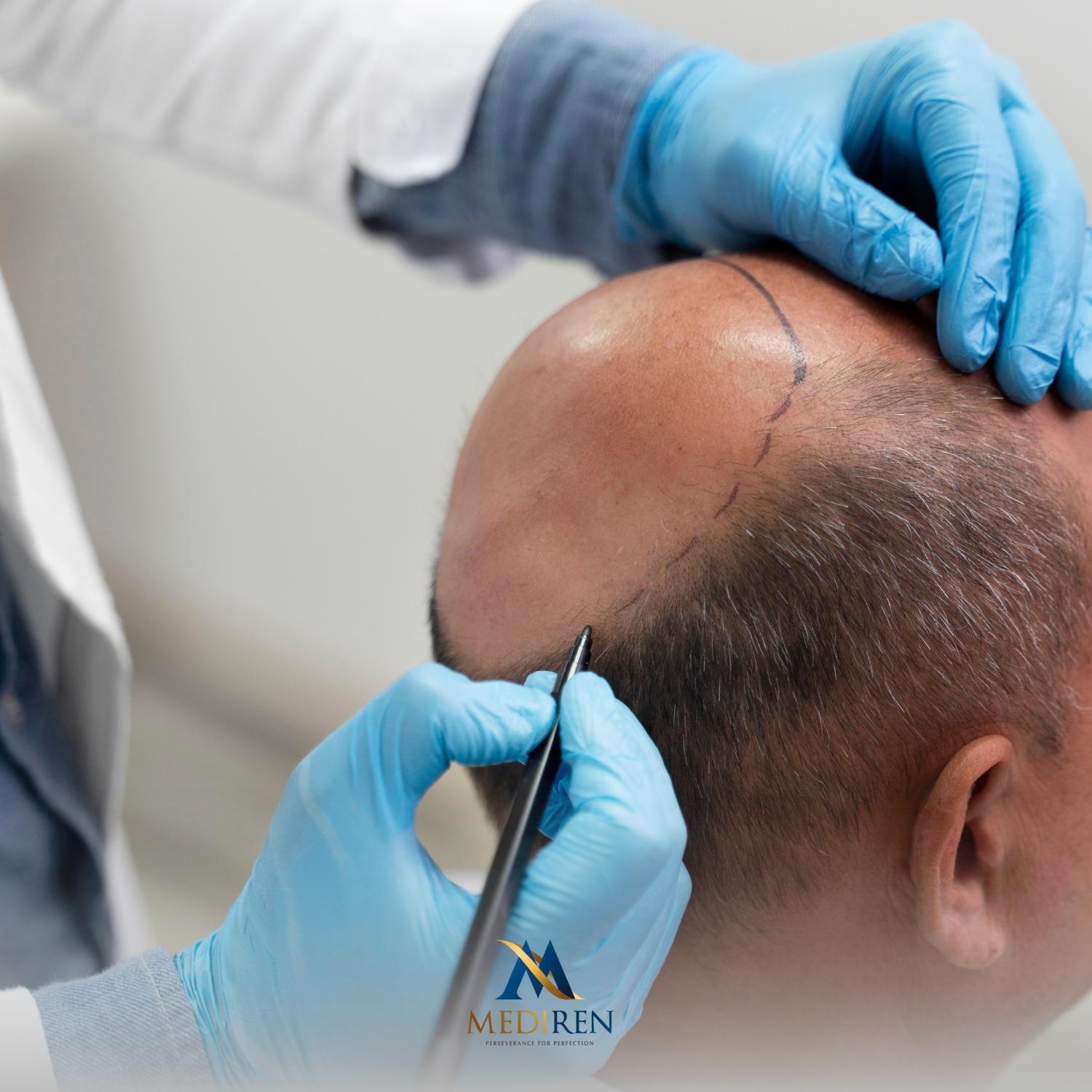 Male Hair Transplant Services