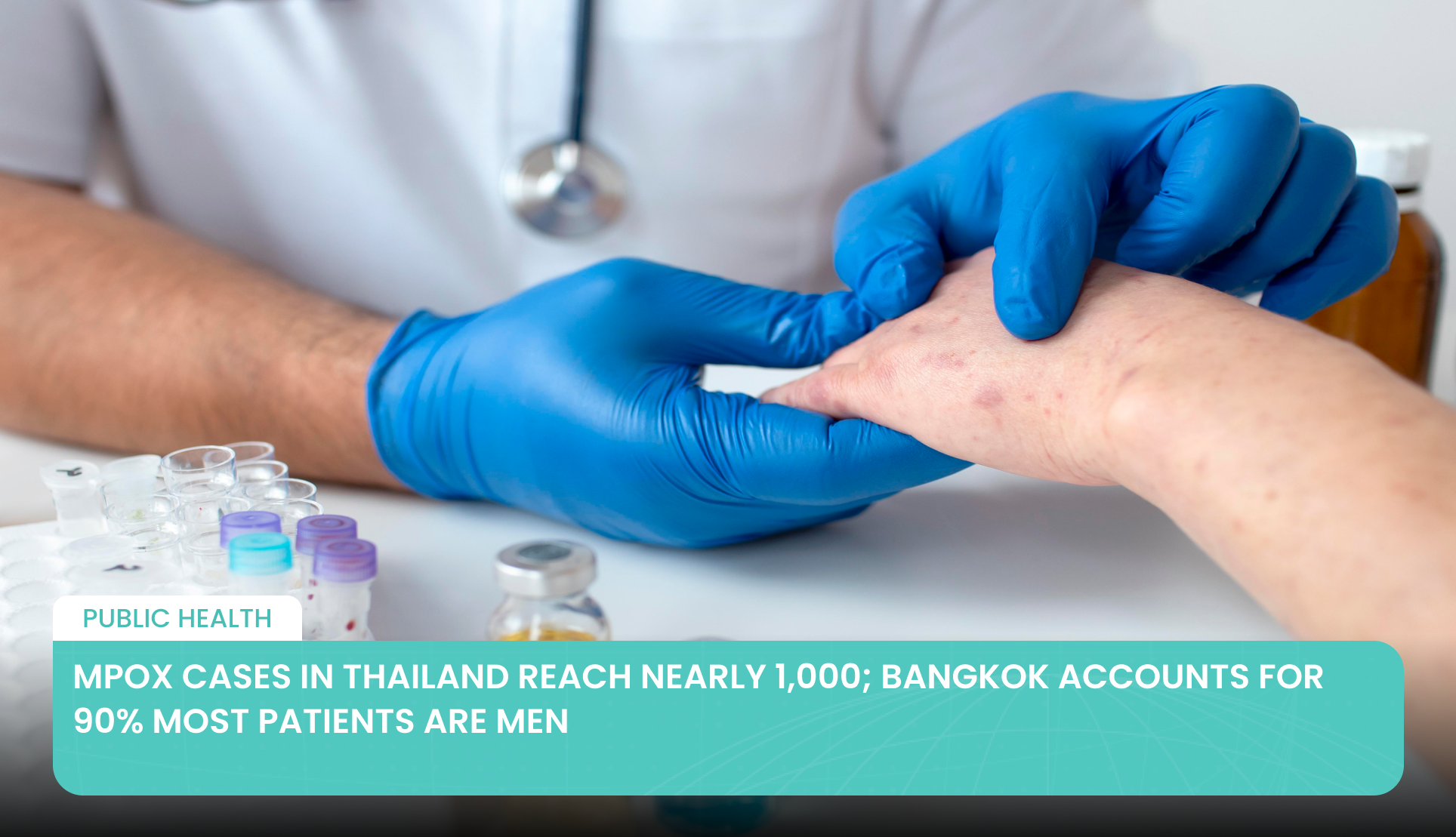 Mpox Cases in Thailand Reach Nearly 1,000; Bangkok Accounts for 90% Most Patients Are Men