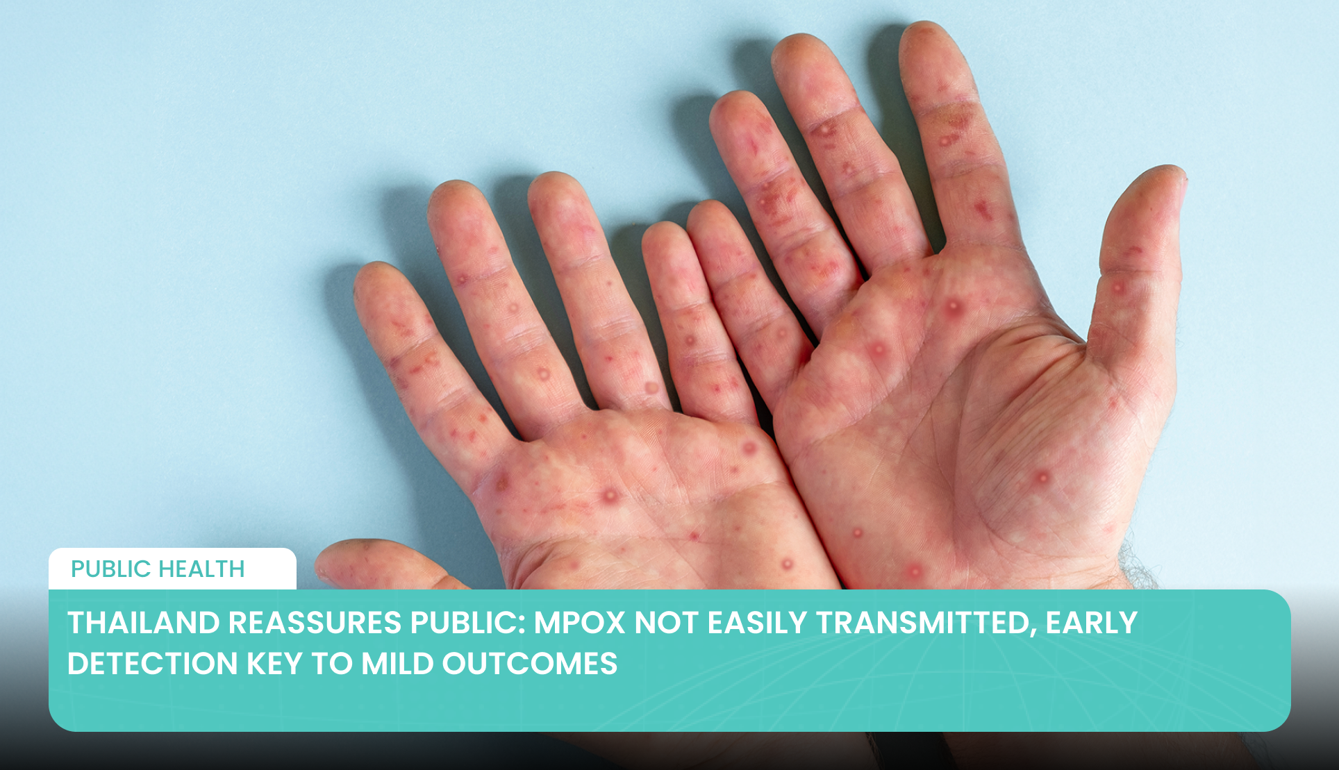 Thailand Reassures Public: Mpox Not Easily Transmitted, Early Detection Key to Mild Outcomes