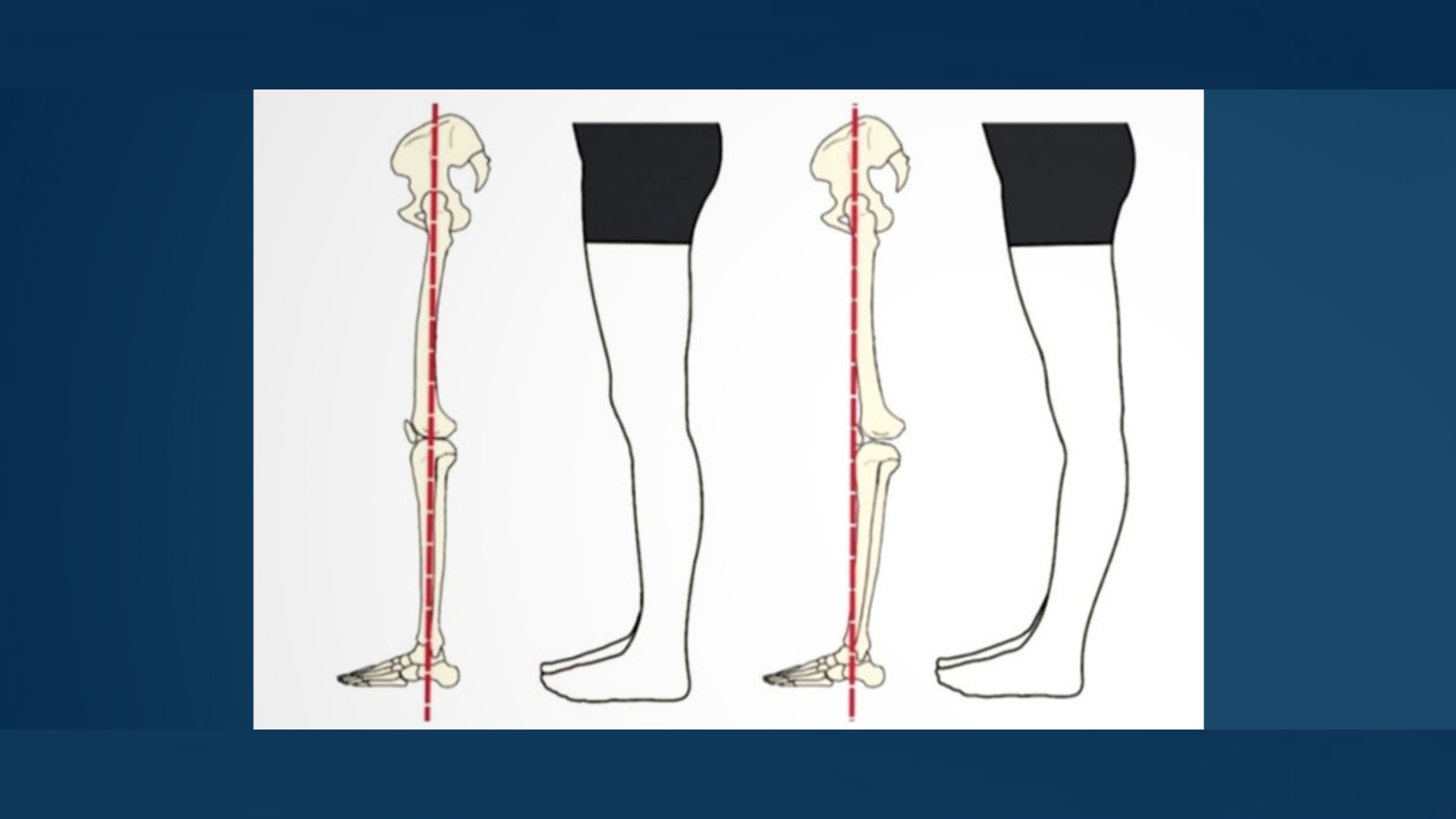 ¿Por qué algunos pacientes con accidente cerebrovascular que tienen buena fuerza en las piernas aún caminan con hiperextensión de la rodilla (genu recurvatum)?
