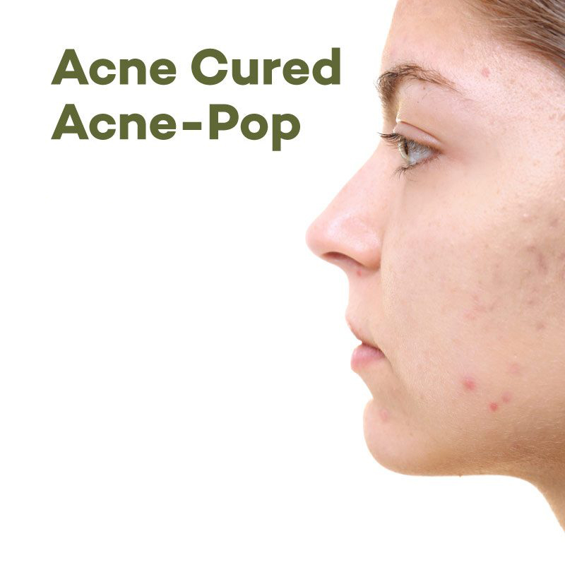 Acne Cured Acne Pop