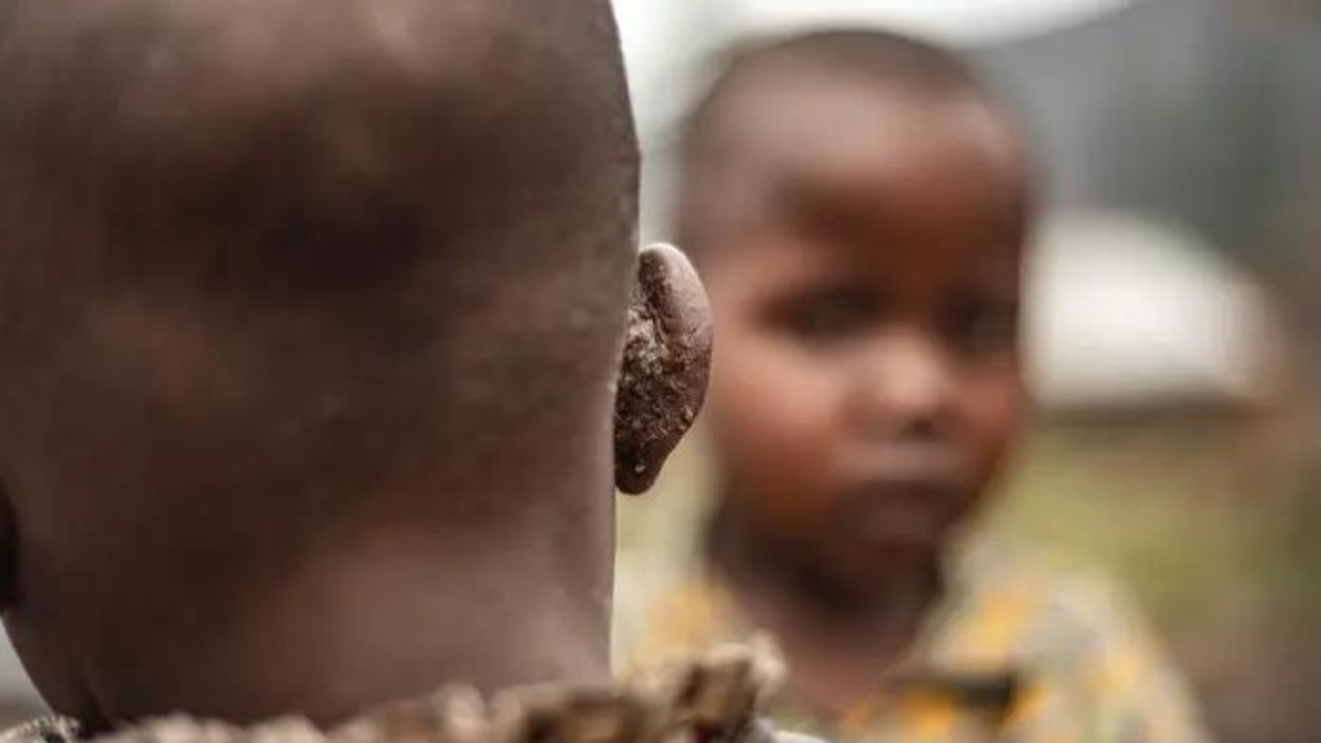 Casos de Mpox en África se acercan a 30,000