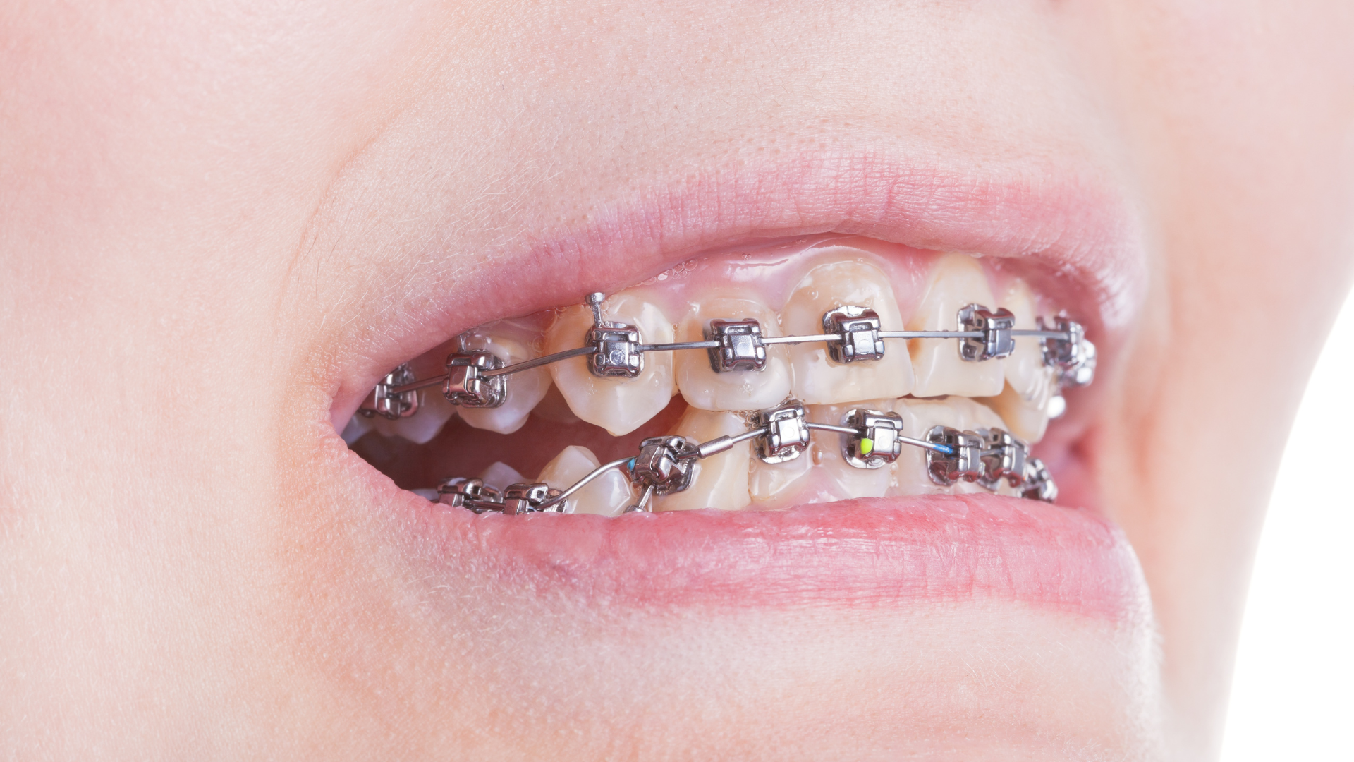 Solving Overlapping and Crowded Teeth with Damon Braces and Clear ...