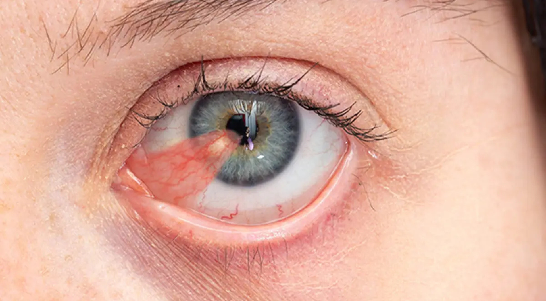Pterygium Treatment Service