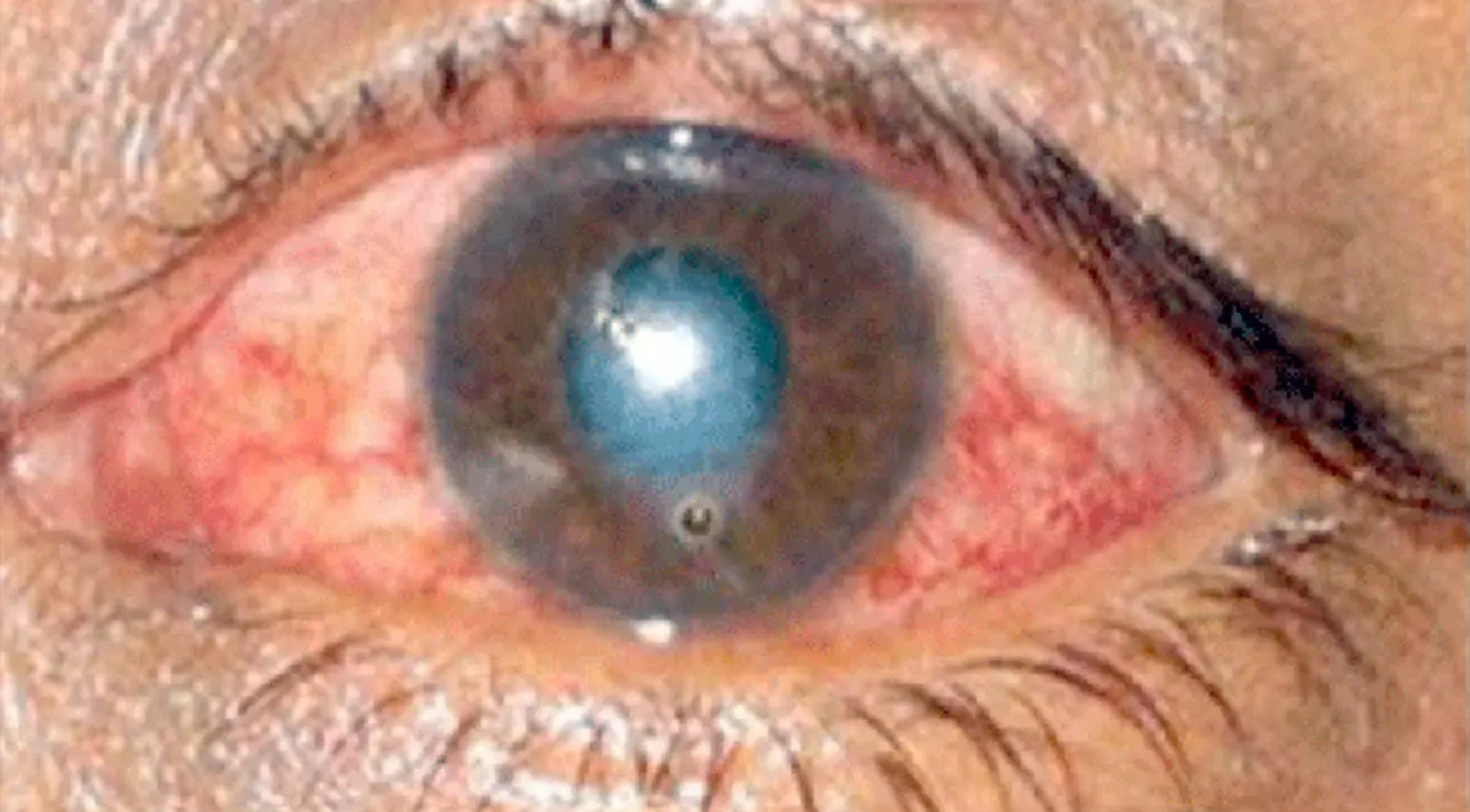 Macular Degeneration (AMD) Treatment Service