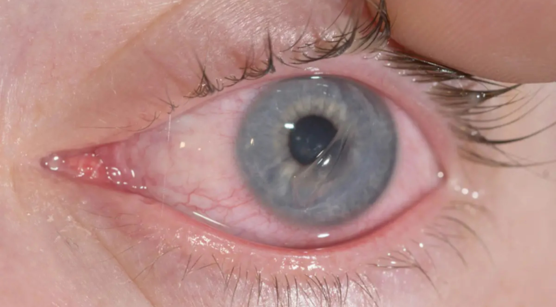 Corneal Abrasion Treatment Service