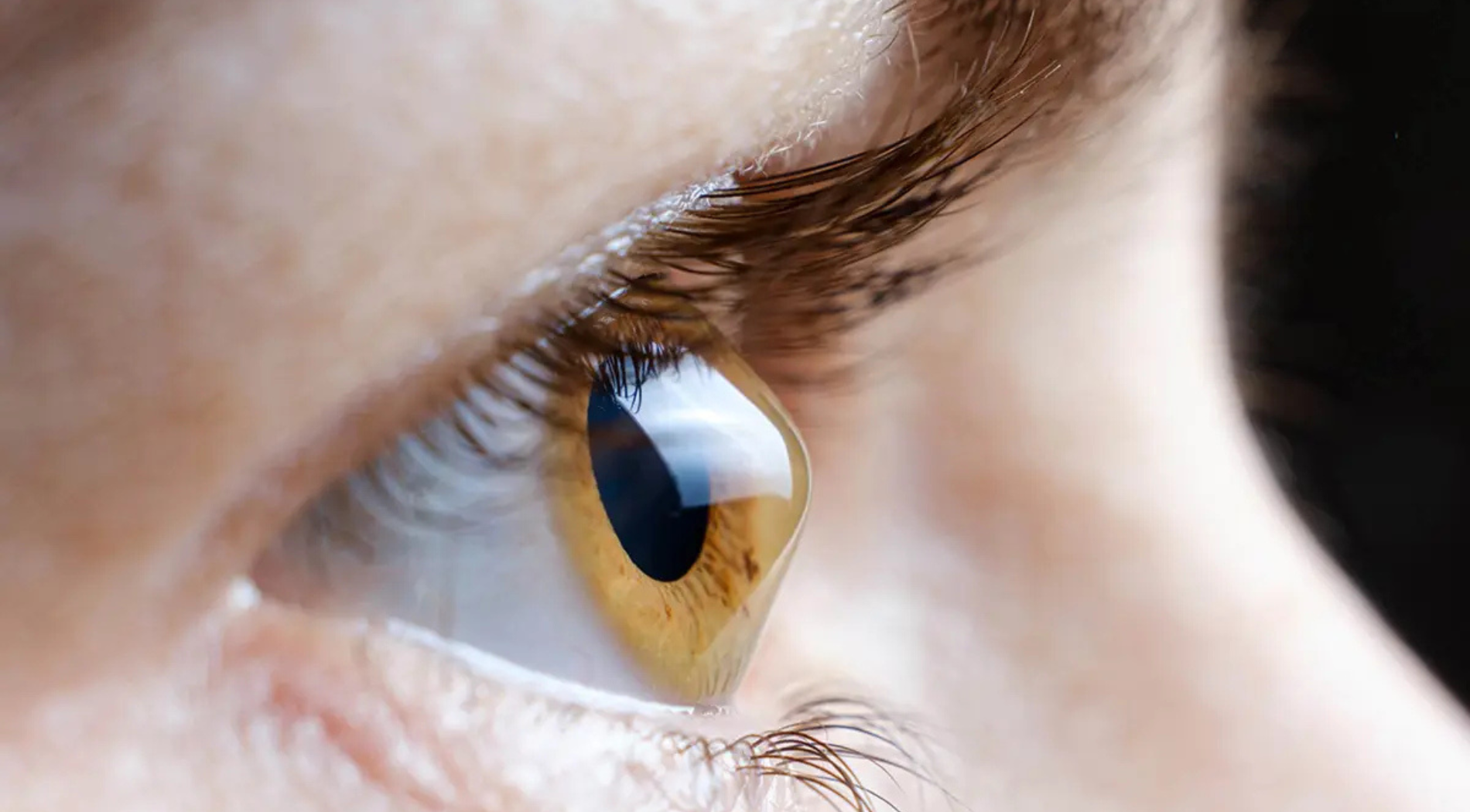 Keratoconus Treatment Service