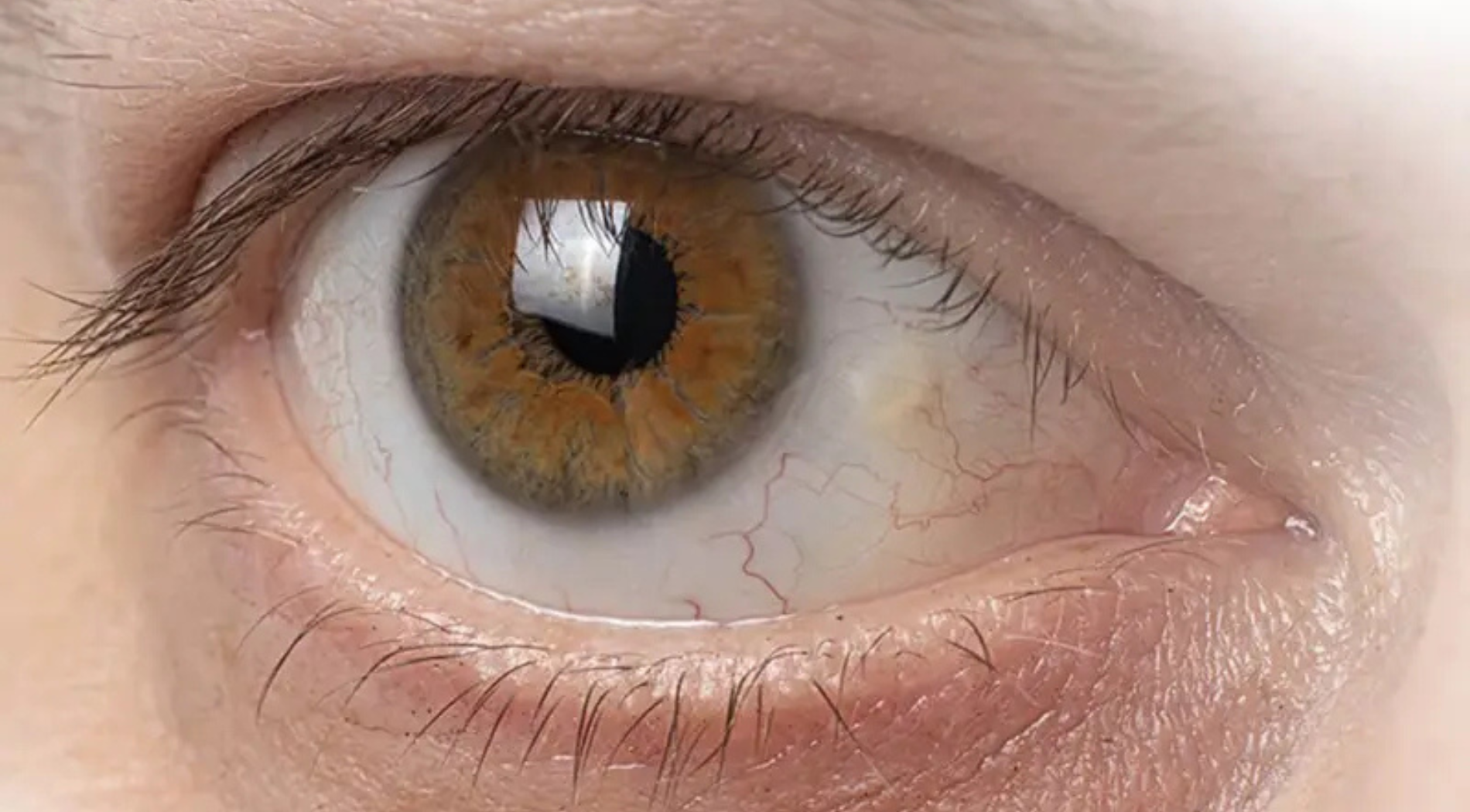 Pinguecula Treatment Service