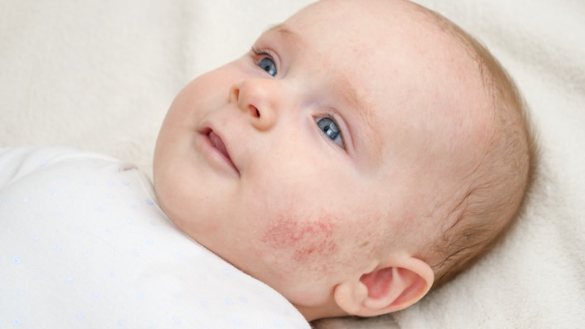 Understanding Baby Acne: A Guide for Parents | ArokaGO - Create Your ...