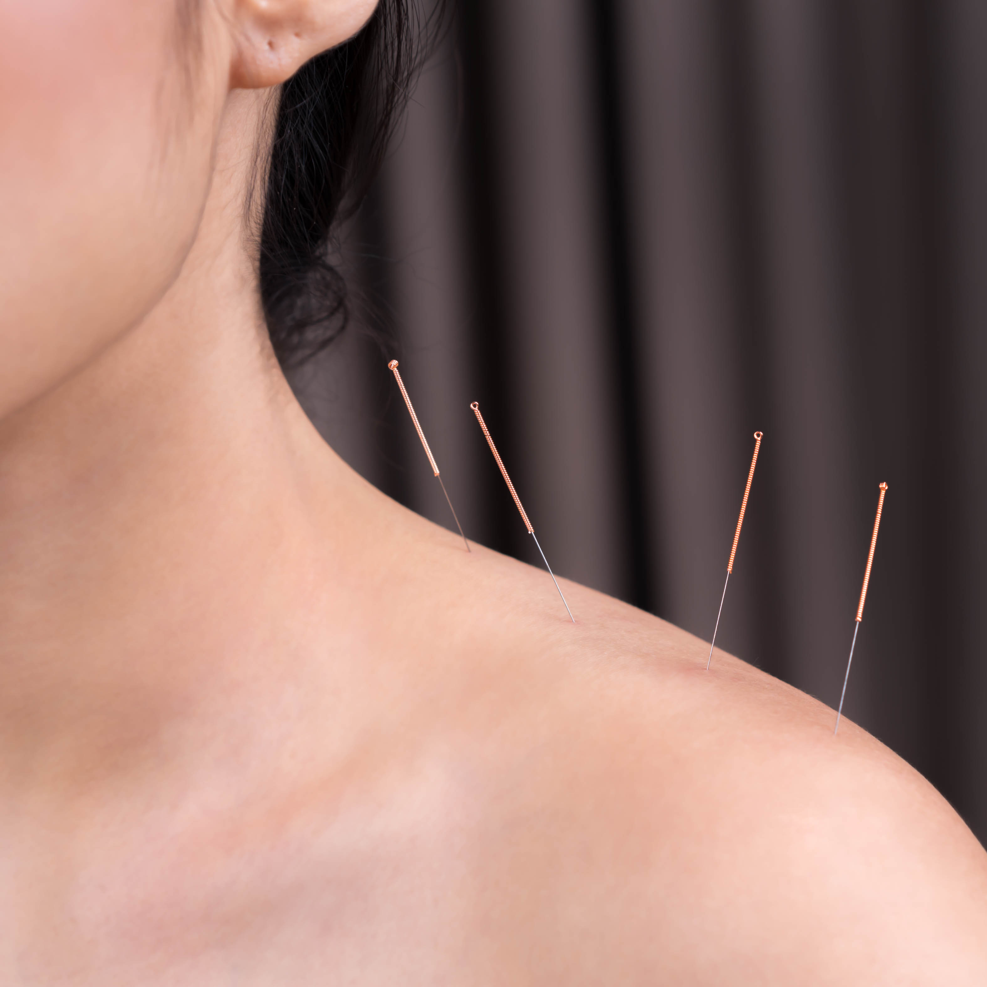 Experience Comprehensive Healing with Acupuncture Treatment